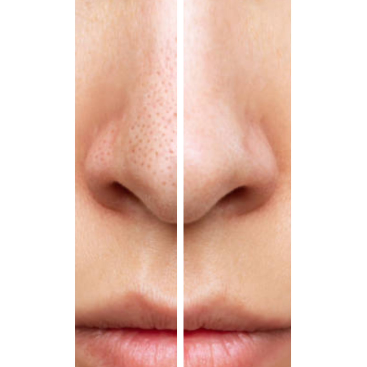 ClearPen – Crayon anti-imperfections à aspiration douce